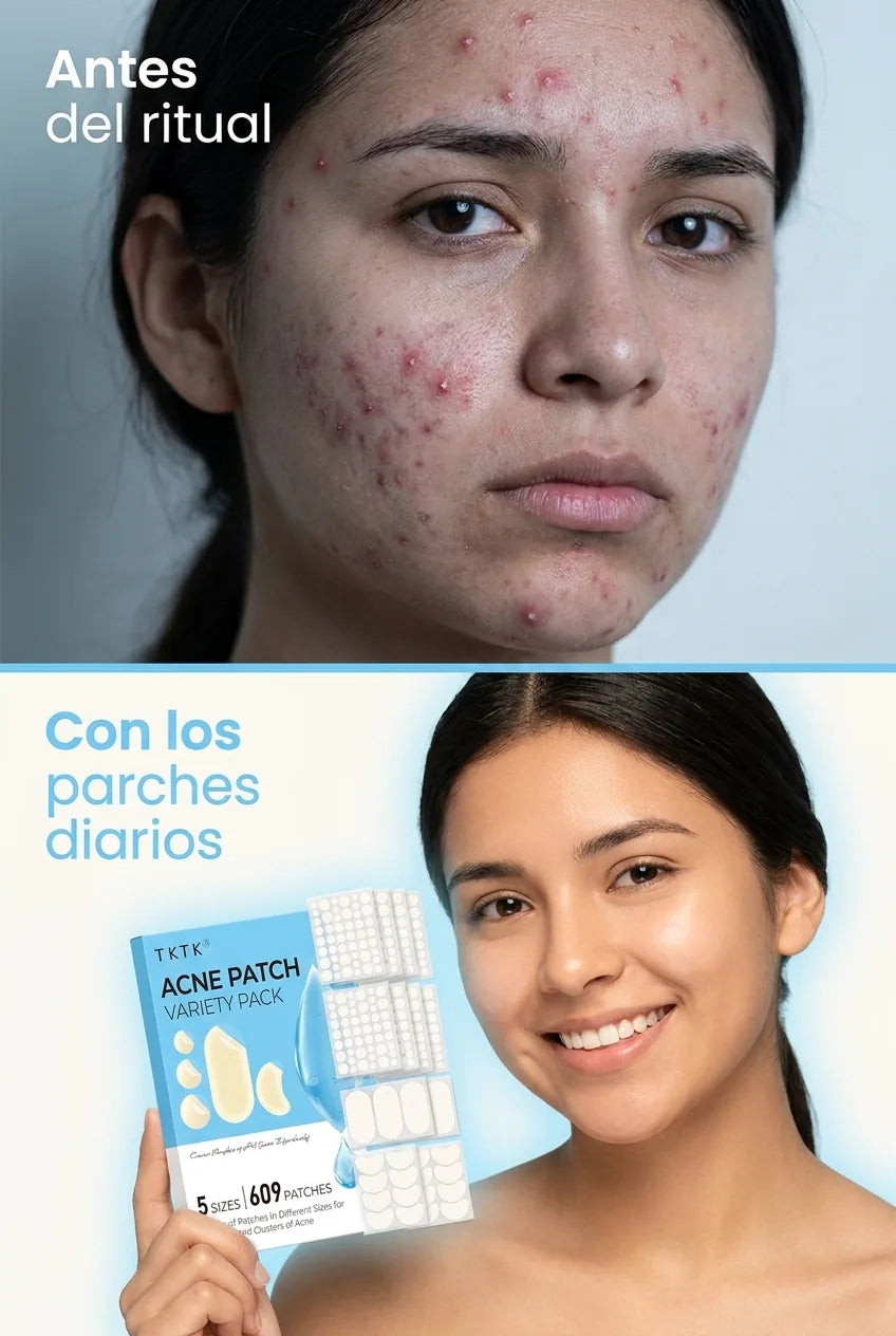 parches-acne-hidrocoloide 03_antes_despues.webp